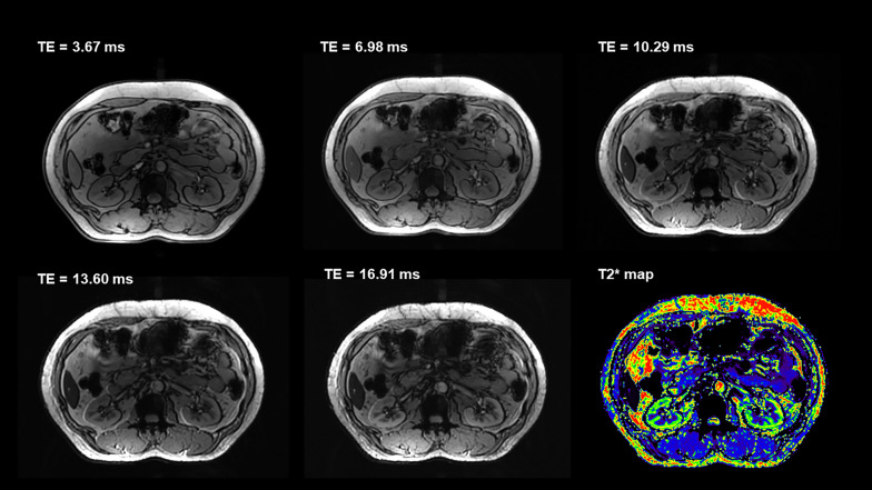 Renal imaging at 5 T versus 3 T: a comparison study - PMC