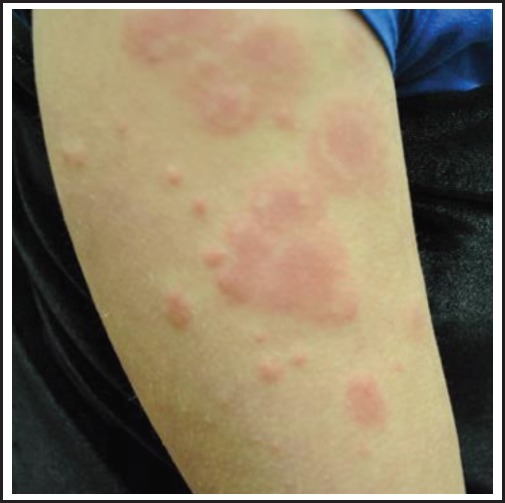 Lupus erythematosus tumidus a unique disease entity pmc