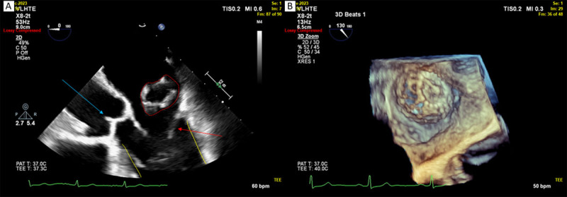 TEE at 2-week follow-up shows device encroaching onto mitral apparatus