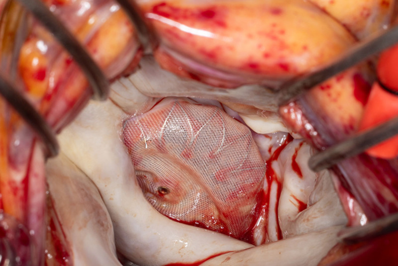 WATCHMAN device visualized intraoperatively inside open left atrium