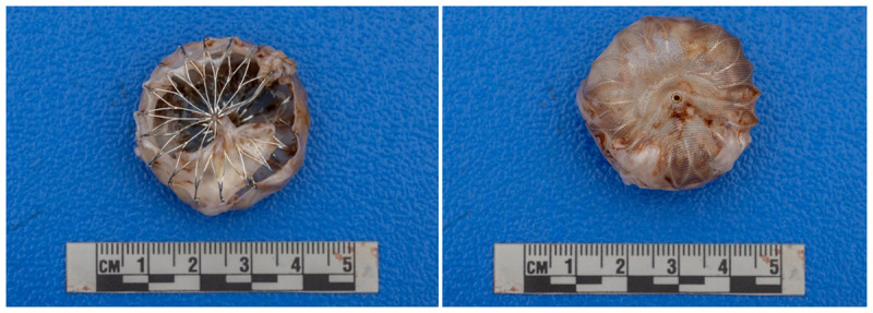 WATCHMAN device after extraction with bottom/top views