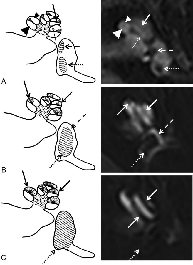 Detection and Grading of Endolymphatic Hydrops in Menière Disease Using MR Imaging PMC