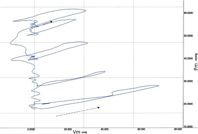 Fig. 3 Main pulmonary arterial pressure (Pm) and velocity (Vm) loops (PU-loops) during the release of Valsalva maneuver from the waveform shown in Fig. 2. The initial part of the first loop, indicating a wave speed of 283 cm/s (solid arrow), became more gentle in accordance with the decrease in diastolic pressure, resulting in a wave speeds of 212 cm/s (dotted arrow) at the last PU-loop.