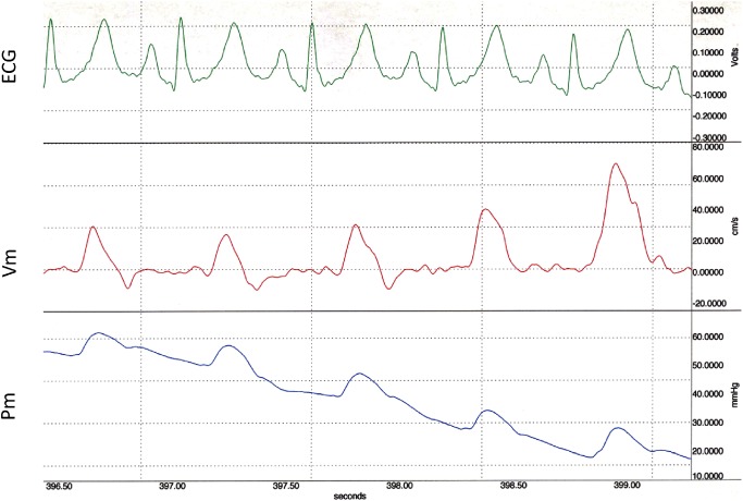 Fig. 2 Simultaneous 5 consecutive flow velocity (Vm) and pressure (Pm) tracings from main pulmonary artery during release of Valsalva maneuver in the same control subject as in Fig. 1a.