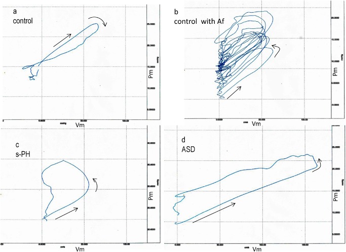 Fig. 1 a: Pulmonary artery pressure and velocity loop during a cardiac cycle in a control subject. b: 10 consecutive pulmonary artery PU-loops in another control patient with atrial fibrillation (Af). c: Pulmonary artery PU-loop during a cardiac cycle in a patient with PH-LHD. d: Pulmonary artery PU-loop during a cardiac cycle in a patient with atrial septal defect (ASD) without pulmonary hypertension.