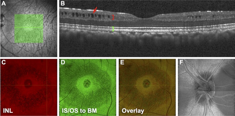 Peripapillary Retinoschisis in Glaucoma: Association With Progression ...