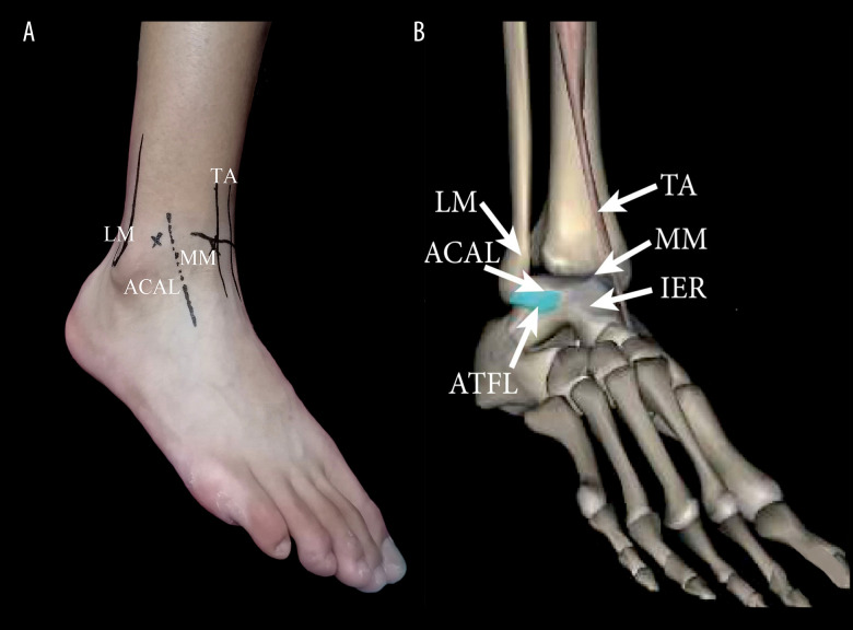 Comparison of Arthroscopic Surgery Versus Open Surgical Repair of the ...