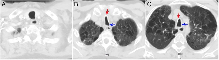 Saber-sheath trachea in a patient with severe COPD - PMC