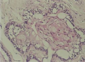 Figure 2: Tall columnar cells.