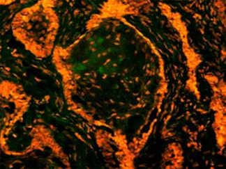 Figure 7: Annexin V is a calcium dependent protein that binds with phospholipid and this FITC tagged annexin V floresed as it stained positive for apoptotic bodies.