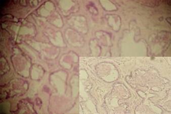 Figure 1: Odontogenic tumuor in connective tissues stroma.