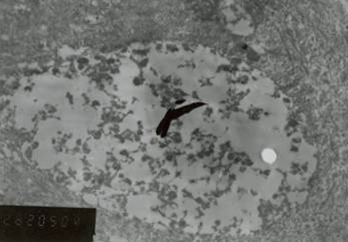 Figure 4: Lysosomal vacules showed phagocytosed material.