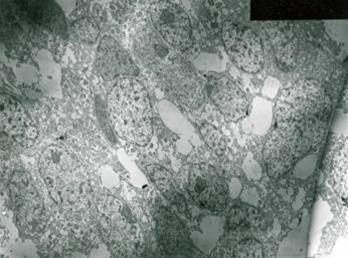 Figure 3: EM examination, granular cell showed lysosomal aggregates.