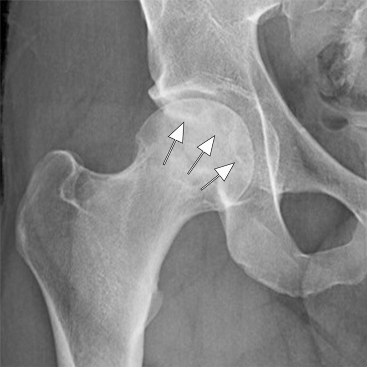 Osteonecrosis in a 29-year-old man who presented with right hip pain. (a) Anteroposterior radiograph and (b) coronal fat-suppressed proton density-weighted MRI of the right hip obtained on the same day show osteonecrosis in the right femoral head, with preserved femoral head contours (arrows). He subsequently went to the sports medicine clinic and was administered a right hip joint intra-articular corticosteroid (IACS) injection for pain. Three months later, he was referred to our institution for repeat IACS injection due to worsening pain. (c) Repeat anteroposterior right hip radiograph shows collapse of the superior femoral head articular surface (arrows). (d) Coronal reformatted CT image of the right hip confirms the collapse of the superior femoral head articular surface (arrows) and shows new hip joint space narrowing. Patient subsequently underwent right hip joint replacement.