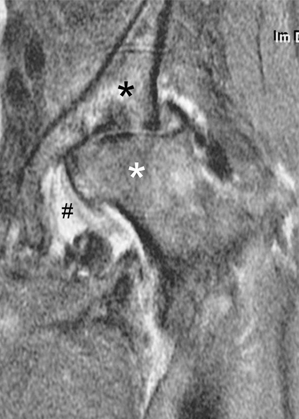 Rapid progressive osteoarthritis type 2 in a 38-year-old woman referred to radiology for intra-articular corticosteroid (IACS) injection. (a) Baseline anteroposterior radiograph of the left hip shows mild osteoarthritis with small definite osteophytes at the lateral acetabulum and femoral head (arrows) and no definite joint space narrowing. (b) Six months after the IACS injection a repeat anteroposterior radiograph of the left hip shows a complete collapse of the head of the femur with marked bone loss of the femoral head (arrow) and surface remodeling and flattening of the acetabulum (arrowheads). (c) Coronal fat-suppressed proton density-weighted MRI scan obtained on the same day demonstrates diffuse bone marrow edema of the femur and acetabulum (black and white *) and a large hip joint effusion (#) reflecting an ongoing process of marked synovial activation.