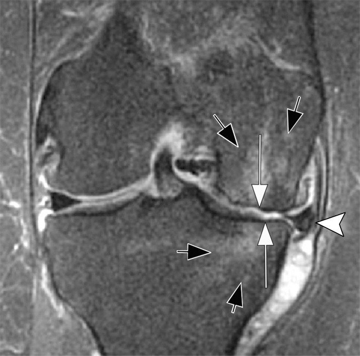 Rapid progressive osteoarthritis (RPOA) type 1 in a 52-year-old man referred to radiology for intra-articular corticosteroid (IACS) injection. (a) Anteroposterior radiograph of the right knee shows mild osteoarthritis with definite osteophytes (arrows) and minimal joint space narrowing of the medial tibiofemoral joint (arrowheads). (b) Baseline coronal fat-suppressed intermediate-weighted MRI scan confirms the osteophytes (black arrows) and shows diffuse cartilage loss at the medial femoral condyle (white arrow) with moderate subluxation of the medial meniscus (arrowhead). (c) Six months after the IACS injection, a repeat anteroposterior radiograph of the right knee shows severe medial tibiofemoral joint space narrowing (arrows) with loss of more than 2 mm of joint space width consistent with rapid progressive osteoarthritis type 1. (d) Coronal fat-suppressed intermediate-weighted MRI scan confirms extensive loss of cartilage at the medial femur and tibia (white arrows) and worsening of the medial meniscal subluxation (arrowhead). There is also subchondral bone marrow edema at the medial tibia and femur (black arrows).