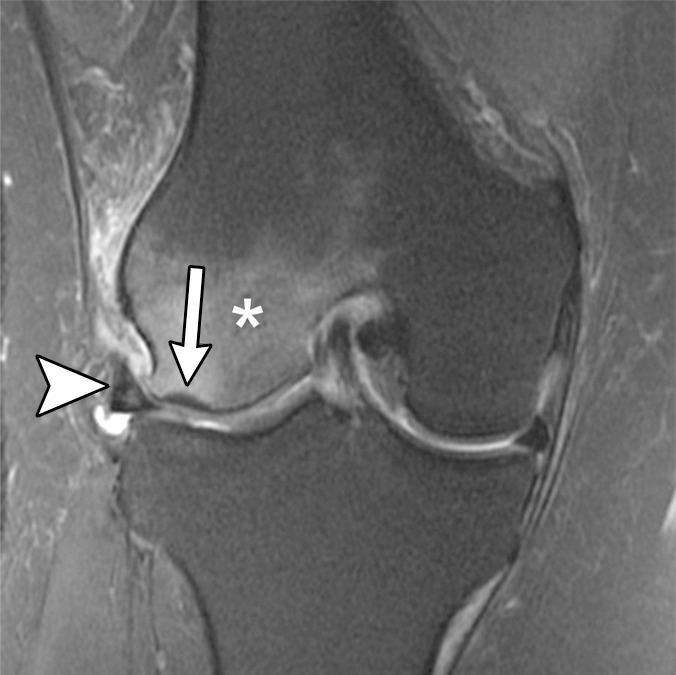 Subchondral insufficiency fracture in a 61-year-old woman with severe knee pain unrelated to trauma referred to radiology for intra-articular corticosteroid (IACS) injection. (a) Anteroposterior radiograph of the right knee obtained the day of the IACS injection shows mild osteoarthritis (OA) with small osteophytes of the lateral tibia and femur (arrows) and no joint space narrowing. (b) Coronal fat-suppressed proton density-weighted MRI performed 1 month after the IACS injection shows subchondral insufficiency fracture (arrow) with extensive bone marrow edema of the lateral femoral condyle (*) and adjacent soft tissue edema. There is also a severe lateral meniscus extrusion (arrowhead). (c) Repeat radiograph of the right knee 3 months later shows the subchondral insufficiency fracture with collapse of the articular contour of the lateral femoral condyle (arrow) surrounded by bone sclerosis (*) and lateral tibiofemoral joint space narrowing (arrowhead) likely secondary to the severe lateral meniscal subluxation. A normal or mild OA baseline radiograph in a patient with severe joint pain as in this case should trigger a preprocedural MRI to depict occult findings of clinical relevance such as subchondral insufficiency fracture.