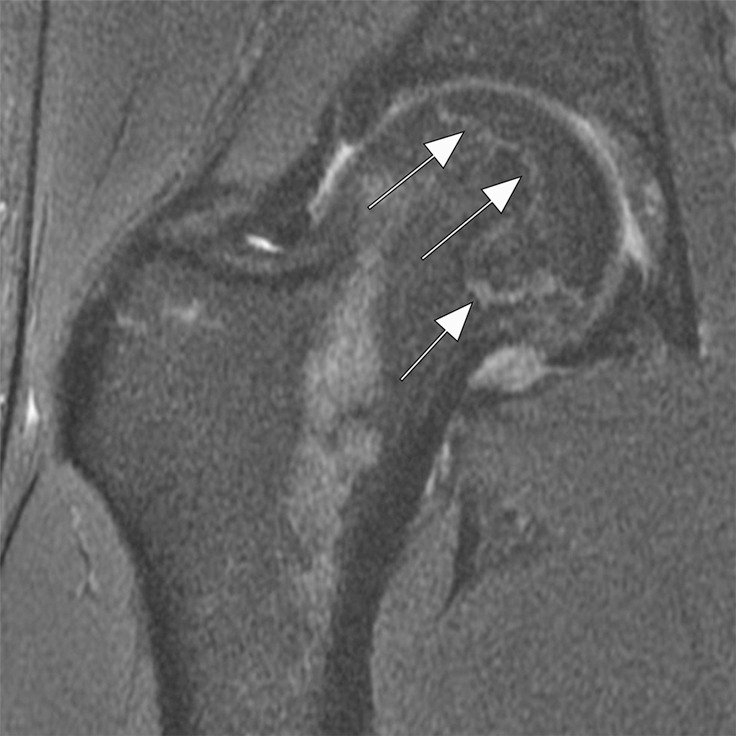 Osteonecrosis in a 29-year-old man who presented with right hip pain. (a) Anteroposterior radiograph and (b) coronal fat-suppressed proton density-weighted MRI of the right hip obtained on the same day show osteonecrosis in the right femoral head, with preserved femoral head contours (arrows). He subsequently went to the sports medicine clinic and was administered a right hip joint intra-articular corticosteroid (IACS) injection for pain. Three months later, he was referred to our institution for repeat IACS injection due to worsening pain. (c) Repeat anteroposterior right hip radiograph shows collapse of the superior femoral head articular surface (arrows). (d) Coronal reformatted CT image of the right hip confirms the collapse of the superior femoral head articular surface (arrows) and shows new hip joint space narrowing. Patient subsequently underwent right hip joint replacement.