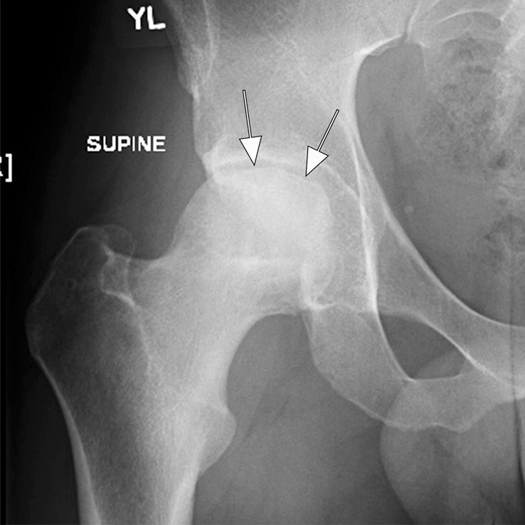 Osteonecrosis in a 29-year-old man who presented with right hip pain. (a) Anteroposterior radiograph and (b) coronal fat-suppressed proton density-weighted MRI of the right hip obtained on the same day show osteonecrosis in the right femoral head, with preserved femoral head contours (arrows). He subsequently went to the sports medicine clinic and was administered a right hip joint intra-articular corticosteroid (IACS) injection for pain. Three months later, he was referred to our institution for repeat IACS injection due to worsening pain. (c) Repeat anteroposterior right hip radiograph shows collapse of the superior femoral head articular surface (arrows). (d) Coronal reformatted CT image of the right hip confirms the collapse of the superior femoral head articular surface (arrows) and shows new hip joint space narrowing. Patient subsequently underwent right hip joint replacement.