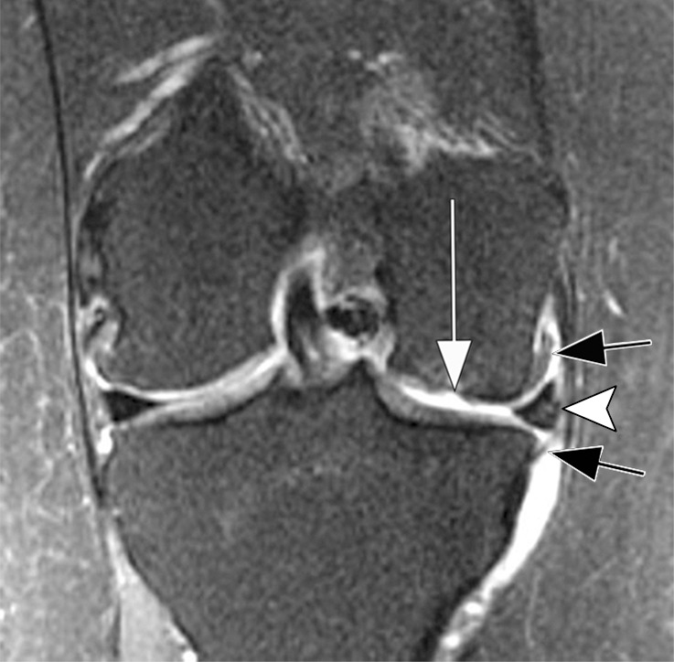 Rapid progressive osteoarthritis (RPOA) type 1 in a 52-year-old man referred to radiology for intra-articular corticosteroid (IACS) injection. (a) Anteroposterior radiograph of the right knee shows mild osteoarthritis with definite osteophytes (arrows) and minimal joint space narrowing of the medial tibiofemoral joint (arrowheads). (b) Baseline coronal fat-suppressed intermediate-weighted MRI scan confirms the osteophytes (black arrows) and shows diffuse cartilage loss at the medial femoral condyle (white arrow) with moderate subluxation of the medial meniscus (arrowhead). (c) Six months after the IACS injection, a repeat anteroposterior radiograph of the right knee shows severe medial tibiofemoral joint space narrowing (arrows) with loss of more than 2 mm of joint space width consistent with rapid progressive osteoarthritis type 1. (d) Coronal fat-suppressed intermediate-weighted MRI scan confirms extensive loss of cartilage at the medial femur and tibia (white arrows) and worsening of the medial meniscal subluxation (arrowhead). There is also subchondral bone marrow edema at the medial tibia and femur (black arrows).