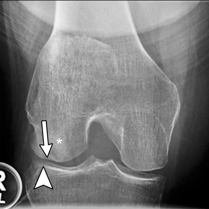 Subchondral insufficiency fracture in a 61-year-old woman with severe knee pain unrelated to trauma referred to radiology for intra-articular corticosteroid (IACS) injection. (a) Anteroposterior radiograph of the right knee obtained the day of the IACS injection shows mild osteoarthritis (OA) with small osteophytes of the lateral tibia and femur (arrows) and no joint space narrowing. (b) Coronal fat-suppressed proton density-weighted MRI performed 1 month after the IACS injection shows subchondral insufficiency fracture (arrow) with extensive bone marrow edema of the lateral femoral condyle (*) and adjacent soft tissue edema. There is also a severe lateral meniscus extrusion (arrowhead). (c) Repeat radiograph of the right knee 3 months later shows the subchondral insufficiency fracture with collapse of the articular contour of the lateral femoral condyle (arrow) surrounded by bone sclerosis (*) and lateral tibiofemoral joint space narrowing (arrowhead) likely secondary to the severe lateral meniscal subluxation. A normal or mild OA baseline radiograph in a patient with severe joint pain as in this case should trigger a preprocedural MRI to depict occult findings of clinical relevance such as subchondral insufficiency fracture.