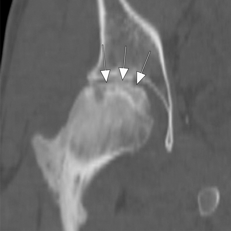 Osteonecrosis in a 29-year-old man who presented with right hip pain. (a) Anteroposterior radiograph and (b) coronal fat-suppressed proton density-weighted MRI of the right hip obtained on the same day show osteonecrosis in the right femoral head, with preserved femoral head contours (arrows). He subsequently went to the sports medicine clinic and was administered a right hip joint intra-articular corticosteroid (IACS) injection for pain. Three months later, he was referred to our institution for repeat IACS injection due to worsening pain. (c) Repeat anteroposterior right hip radiograph shows collapse of the superior femoral head articular surface (arrows). (d) Coronal reformatted CT image of the right hip confirms the collapse of the superior femoral head articular surface (arrows) and shows new hip joint space narrowing. Patient subsequently underwent right hip joint replacement.