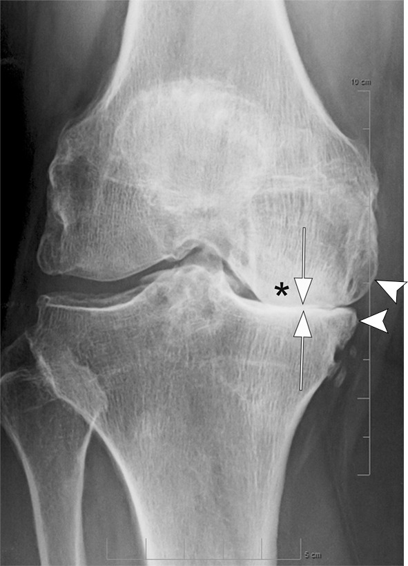 Osteonecrosis in a 59-year-old man referred to radiology for intra-articular corticosteroid (IACS) injection. (a) Anteroposterior radiograph of the right knee shows severe osteoarthritis with bone on bone appearance (arrows) and large definite osteophytes (arrowheads). There is a subchondral sclerosis of the medial femoral condyle (*), which is expected in advanced osteoarthritis. No sign of subchondral insufficiency fracture or osteonecrosis. Patient was experiencing an acute episode of pain exacerbation at time of presentation. (b) Coronal fat-suppressed intermediate-weighted MRI was performed before the IACS injection and discloses a large area of osteonecrosis of the medial femoral condyle (arrows) with pathognomonic serpiginous demarcation and fat-equivalent center of lesion (*). No collapse of the articular contour is seen. There is attrition (ie, surface remodeling) as part of the advanced osteoarthritis process. IACS injection was not performed.