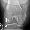Subchondral insufficiency fracture in a 61-year-old woman with severe knee pain unrelated to trauma referred to radiology for intra-articular corticosteroid (IACS) injection. (a) Anteroposterior radiograph of the right knee obtained the day of the IACS injection shows mild osteoarthritis (OA) with small osteophytes of the lateral tibia and femur (arrows) and no joint space narrowing. (b) Coronal fat-suppressed proton density-weighted MRI performed 1 month after the IACS injection shows subchondral insufficiency fracture (arrow) with extensive bone marrow edema of the lateral femoral condyle (*) and adjacent soft tissue edema. There is also a severe lateral meniscus extrusion (arrowhead). (c) Repeat radiograph of the right knee 3 months later shows the subchondral insufficiency fracture with collapse of the articular contour of the lateral femoral condyle (arrow) surrounded by bone sclerosis (*) and lateral tibiofemoral joint space narrowing (arrowhead) likely secondary to the severe lateral meniscal subluxation. A normal or mild OA baseline radiograph in a patient with severe joint pain as in this case should trigger a preprocedural MRI to depict occult findings of clinical relevance such as subchondral insufficiency fracture.