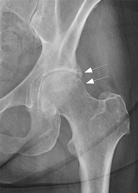 Rapid progressive osteoarthritis type 2 in a 38-year-old woman referred to radiology for intra-articular corticosteroid (IACS) injection. (a) Baseline anteroposterior radiograph of the left hip shows mild osteoarthritis with small definite osteophytes at the lateral acetabulum and femoral head (arrows) and no definite joint space narrowing. (b) Six months after the IACS injection a repeat anteroposterior radiograph of the left hip shows a complete collapse of the head of the femur with marked bone loss of the femoral head (arrow) and surface remodeling and flattening of the acetabulum (arrowheads). (c) Coronal fat-suppressed proton density-weighted MRI scan obtained on the same day demonstrates diffuse bone marrow edema of the femur and acetabulum (black and white *) and a large hip joint effusion (#) reflecting an ongoing process of marked synovial activation.