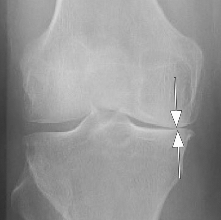 Rapid progressive osteoarthritis (RPOA) type 1 in a 52-year-old man referred to radiology for intra-articular corticosteroid (IACS) injection. (a) Anteroposterior radiograph of the right knee shows mild osteoarthritis with definite osteophytes (arrows) and minimal joint space narrowing of the medial tibiofemoral joint (arrowheads). (b) Baseline coronal fat-suppressed intermediate-weighted MRI scan confirms the osteophytes (black arrows) and shows diffuse cartilage loss at the medial femoral condyle (white arrow) with moderate subluxation of the medial meniscus (arrowhead). (c) Six months after the IACS injection, a repeat anteroposterior radiograph of the right knee shows severe medial tibiofemoral joint space narrowing (arrows) with loss of more than 2 mm of joint space width consistent with rapid progressive osteoarthritis type 1. (d) Coronal fat-suppressed intermediate-weighted MRI scan confirms extensive loss of cartilage at the medial femur and tibia (white arrows) and worsening of the medial meniscal subluxation (arrowhead). There is also subchondral bone marrow edema at the medial tibia and femur (black arrows).