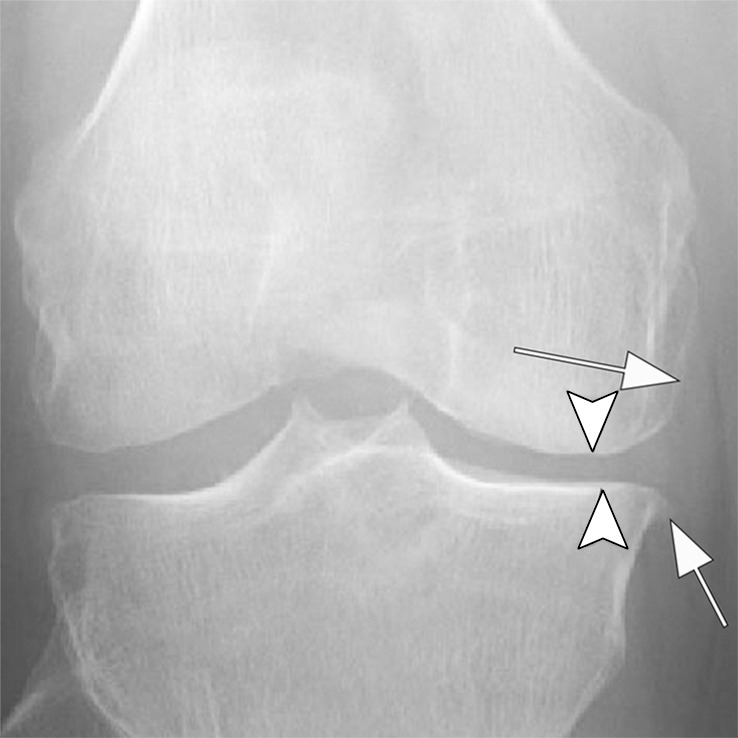 Rapid progressive osteoarthritis (RPOA) type 1 in a 52-year-old man referred to radiology for intra-articular corticosteroid (IACS) injection. (a) Anteroposterior radiograph of the right knee shows mild osteoarthritis with definite osteophytes (arrows) and minimal joint space narrowing of the medial tibiofemoral joint (arrowheads). (b) Baseline coronal fat-suppressed intermediate-weighted MRI scan confirms the osteophytes (black arrows) and shows diffuse cartilage loss at the medial femoral condyle (white arrow) with moderate subluxation of the medial meniscus (arrowhead). (c) Six months after the IACS injection, a repeat anteroposterior radiograph of the right knee shows severe medial tibiofemoral joint space narrowing (arrows) with loss of more than 2 mm of joint space width consistent with rapid progressive osteoarthritis type 1. (d) Coronal fat-suppressed intermediate-weighted MRI scan confirms extensive loss of cartilage at the medial femur and tibia (white arrows) and worsening of the medial meniscal subluxation (arrowhead). There is also subchondral bone marrow edema at the medial tibia and femur (black arrows).