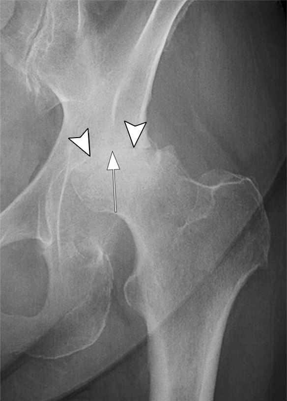 Rapid progressive osteoarthritis type 2 in a 38-year-old woman referred to radiology for intra-articular corticosteroid (IACS) injection. (a) Baseline anteroposterior radiograph of the left hip shows mild osteoarthritis with small definite osteophytes at the lateral acetabulum and femoral head (arrows) and no definite joint space narrowing. (b) Six months after the IACS injection a repeat anteroposterior radiograph of the left hip shows a complete collapse of the head of the femur with marked bone loss of the femoral head (arrow) and surface remodeling and flattening of the acetabulum (arrowheads). (c) Coronal fat-suppressed proton density-weighted MRI scan obtained on the same day demonstrates diffuse bone marrow edema of the femur and acetabulum (black and white *) and a large hip joint effusion (#) reflecting an ongoing process of marked synovial activation.