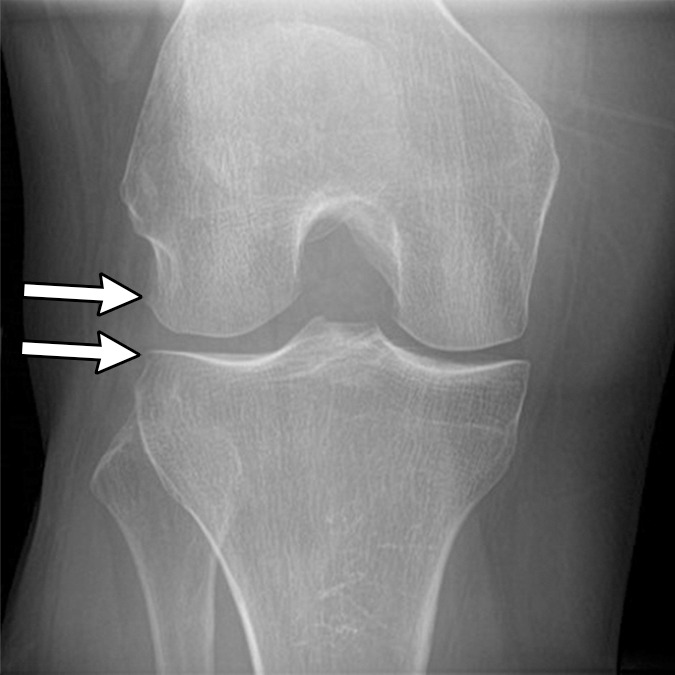 Subchondral insufficiency fracture in a 61-year-old woman with severe knee pain unrelated to trauma referred to radiology for intra-articular corticosteroid (IACS) injection. (a) Anteroposterior radiograph of the right knee obtained the day of the IACS injection shows mild osteoarthritis (OA) with small osteophytes of the lateral tibia and femur (arrows) and no joint space narrowing. (b) Coronal fat-suppressed proton density-weighted MRI performed 1 month after the IACS injection shows subchondral insufficiency fracture (arrow) with extensive bone marrow edema of the lateral femoral condyle (*) and adjacent soft tissue edema. There is also a severe lateral meniscus extrusion (arrowhead). (c) Repeat radiograph of the right knee 3 months later shows the subchondral insufficiency fracture with collapse of the articular contour of the lateral femoral condyle (arrow) surrounded by bone sclerosis (*) and lateral tibiofemoral joint space narrowing (arrowhead) likely secondary to the severe lateral meniscal subluxation. A normal or mild OA baseline radiograph in a patient with severe joint pain as in this case should trigger a preprocedural MRI to depict occult findings of clinical relevance such as subchondral insufficiency fracture.