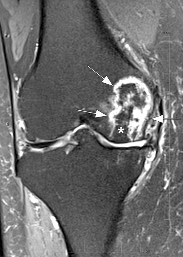 Osteonecrosis in a 59-year-old man referred to radiology for intra-articular corticosteroid (IACS) injection. (a) Anteroposterior radiograph of the right knee shows severe osteoarthritis with bone on bone appearance (arrows) and large definite osteophytes (arrowheads). There is a subchondral sclerosis of the medial femoral condyle (*), which is expected in advanced osteoarthritis. No sign of subchondral insufficiency fracture or osteonecrosis. Patient was experiencing an acute episode of pain exacerbation at time of presentation. (b) Coronal fat-suppressed intermediate-weighted MRI was performed before the IACS injection and discloses a large area of osteonecrosis of the medial femoral condyle (arrows) with pathognomonic serpiginous demarcation and fat-equivalent center of lesion (*). No collapse of the articular contour is seen. There is attrition (ie, surface remodeling) as part of the advanced osteoarthritis process. IACS injection was not performed.