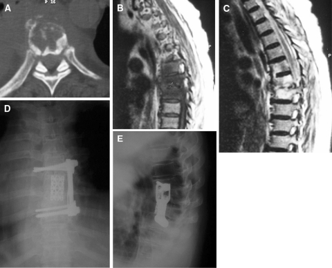 Anterior Instrumentation For The Treatment Of Pyogenic Vertebral 