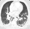 A patient with COVID-19 with bilateral pulmonary emboli had d-dimer level of >10 000 ng/mL. (a) Coronal CT pulmonary angiographic image identifies bilateral pulmonary emboli that involve the left main pulmonary artery, distal right main pulmonary artery, right upper lobe pulmonary artery, and proximal segmental vessels. (b) On an axial CT pulmonary angiographic image, there is an embolus present in the left main and right upper lobe pulmonary arteries extending into the bilateral anterior segmental artery. ObstTotRatio was 0.674. (c) A ground-glass opacity is present in the right upper lobe centrally with a reversed halo appearance, peripheral dense area, and central ground-glass opacity with prominent vessels attributed to lung involvement from COVID-19. (d) Axial image through the lung base demonstrates basilar consolidation compatible with COVID-19.
