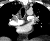 A patient with COVID-19 with bilateral pulmonary emboli had d-dimer level of >10 000 ng/mL. (a) Coronal CT pulmonary angiographic image identifies bilateral pulmonary emboli that involve the left main pulmonary artery, distal right main pulmonary artery, right upper lobe pulmonary artery, and proximal segmental vessels. (b) On an axial CT pulmonary angiographic image, there is an embolus present in the left main and right upper lobe pulmonary arteries extending into the bilateral anterior segmental artery. ObstTotRatio was 0.674. (c) A ground-glass opacity is present in the right upper lobe centrally with a reversed halo appearance, peripheral dense area, and central ground-glass opacity with prominent vessels attributed to lung involvement from COVID-19. (d) Axial image through the lung base demonstrates basilar consolidation compatible with COVID-19.