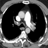 A patient with COVID-19 with bilateral pulmonary emboli had d-dimer level of >10 000 ng/mL. (a) Coronal CT pulmonary angiographic image identifies bilateral pulmonary emboli that involve the left main pulmonary artery, distal right main pulmonary artery, right upper lobe pulmonary artery, and proximal segmental vessels. (b) On an axial CT pulmonary angiographic image, there is an embolus present in the left main and right upper lobe pulmonary arteries extending into the bilateral anterior segmental artery. ObstTotRatio was 0.674. (c) A ground-glass opacity is present in the right upper lobe centrally with a reversed halo appearance, peripheral dense area, and central ground-glass opacity with prominent vessels attributed to lung involvement from COVID-19. (d) Axial image through the lung base demonstrates basilar consolidation compatible with COVID-19.