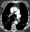 A patient with COVID-19 with bilateral pulmonary emboli had a d-dimer level of >10 000 ng/mL, 4 days after admission. (a) Axial CT pulmonary angiographic image shows bilateral pulmonary emboli in the left main pulmonary artery and right upper lobe proximal segmental vessels. (b) On an image in the lower thorax, the right ventricle is larger than the left ventricle indicating right heart strain. (c) Bilateral parenchymal consolidative and ground-glass opacities are present with a peripheral orientation in the right upper lobe and left lower lobe superior segments. Central and peripheral ground glass in the left-upper lobe is present. ObstTotRatio was 0.568.