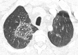 A patient with COVID-19 with bilateral pulmonary emboli had d-dimer level of >10 000 ng/mL. (a) Coronal CT pulmonary angiographic image identifies bilateral pulmonary emboli that involve the left main pulmonary artery, distal right main pulmonary artery, right upper lobe pulmonary artery, and proximal segmental vessels. (b) On an axial CT pulmonary angiographic image, there is an embolus present in the left main and right upper lobe pulmonary arteries extending into the bilateral anterior segmental artery. ObstTotRatio was 0.674. (c) A ground-glass opacity is present in the right upper lobe centrally with a reversed halo appearance, peripheral dense area, and central ground-glass opacity with prominent vessels attributed to lung involvement from COVID-19. (d) Axial image through the lung base demonstrates basilar consolidation compatible with COVID-19.