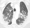 A patient with COVID-19 with bilateral pulmonary emboli had a d-dimer level of >10 000 ng/mL, 4 days after admission. (a) Axial CT pulmonary angiographic image shows bilateral pulmonary emboli in the left main pulmonary artery and right upper lobe proximal segmental vessels. (b) On an image in the lower thorax, the right ventricle is larger than the left ventricle indicating right heart strain. (c) Bilateral parenchymal consolidative and ground-glass opacities are present with a peripheral orientation in the right upper lobe and left lower lobe superior segments. Central and peripheral ground glass in the left-upper lobe is present. ObstTotRatio was 0.568.