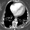 A patient with COVID-19 with bilateral pulmonary emboli had a d-dimer level of >10 000 ng/mL, 4 days after admission. (a) Axial CT pulmonary angiographic image shows bilateral pulmonary emboli in the left main pulmonary artery and right upper lobe proximal segmental vessels. (b) On an image in the lower thorax, the right ventricle is larger than the left ventricle indicating right heart strain. (c) Bilateral parenchymal consolidative and ground-glass opacities are present with a peripheral orientation in the right upper lobe and left lower lobe superior segments. Central and peripheral ground glass in the left-upper lobe is present. ObstTotRatio was 0.568.