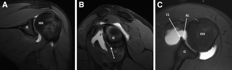 Understanding the Glenoid Avulsion of the Glenohumeral Ligaments as a ...