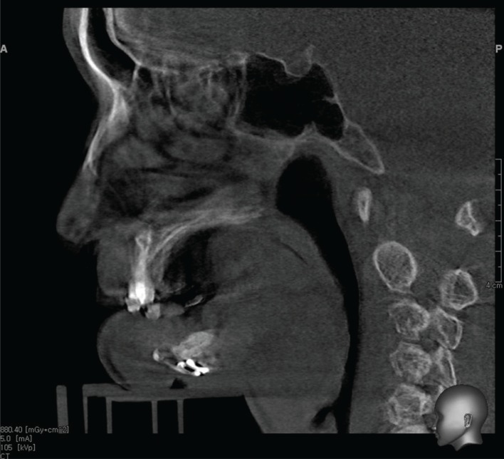 Difficult airway management in a patient with a thin mandible PMC Difficult airway management in a patient with a thin mandible PMC