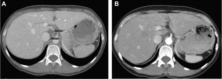 Figure 4. CT scan images from a patient with a KRAS G12D mutation and a sustained complete response while on treatment with binimetinib. A, CT scan at study enrollment in 2015. B, CT scan in 2020 displaying sustained complete response with resolution of perihepatic adenopathy.