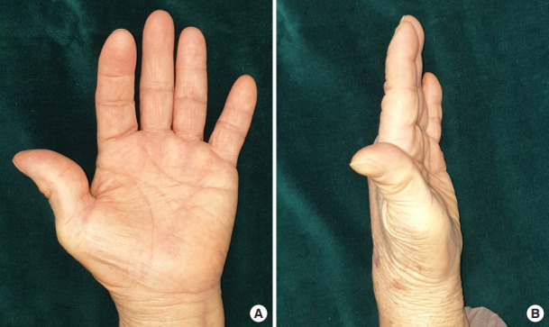 Closed Extensor Tendon Rupture Caused By Kienböck Disease: A Case 