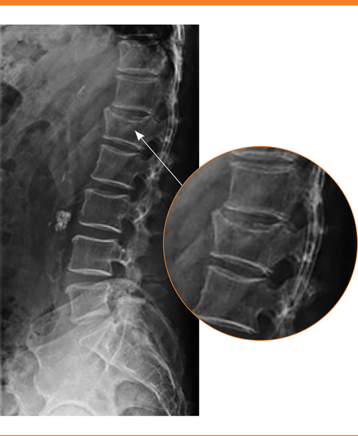 Spinal X-ray with magnification of compression fracture of L1 vertebra