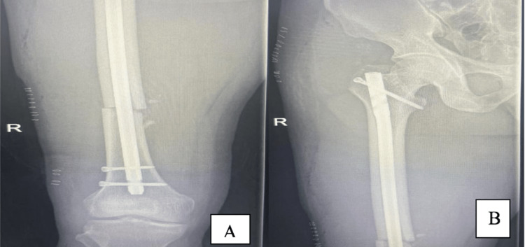 Ipsilateral Foot Drop After Leg Traction On Fracture Table For Mid