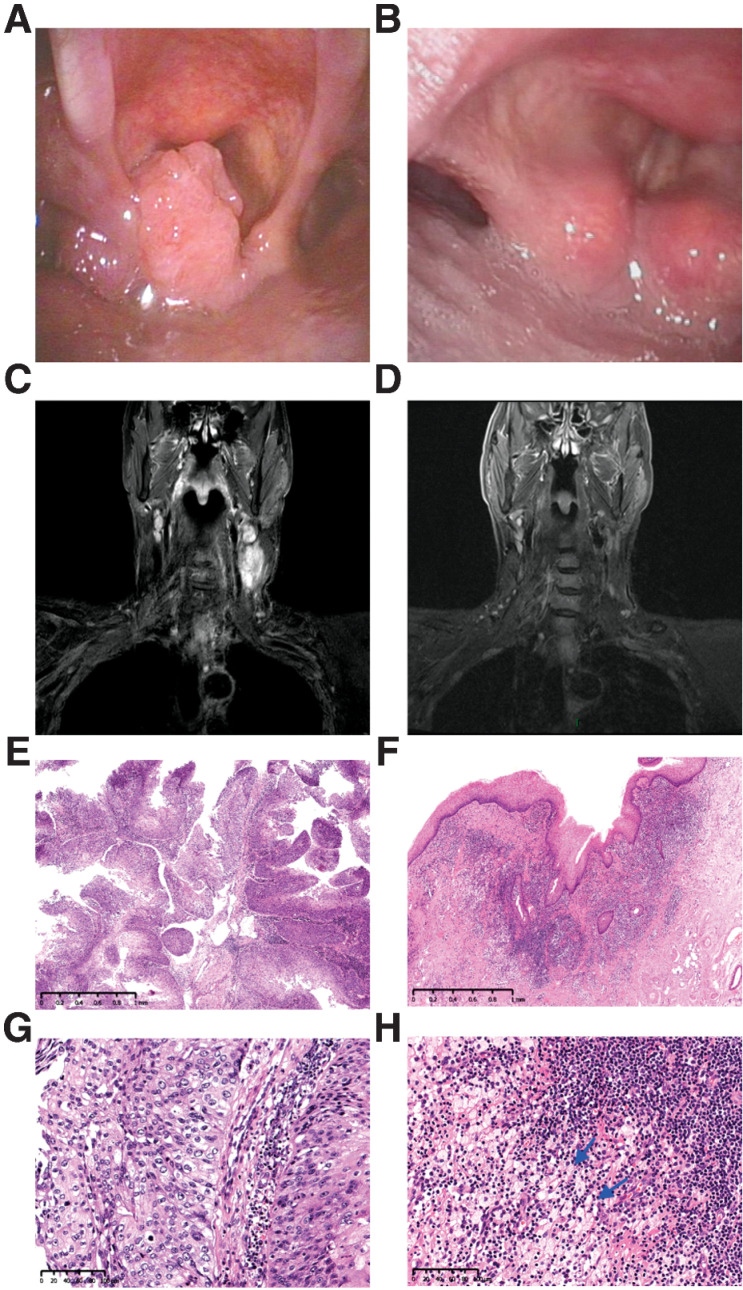 Figure 4. Tumor regression in a 61-year-old man with stage IVA hypopharyngeal cancer (T2N2cM0, P21). The tumor was PD-L1 positive (combined positive score = 10) and originated in the left pyriform sinus. A, Pretreatment image showed a cT2 squamous cell carcinoma of the left pyriform sinus. B, Pretreatment MR imaging showed bilateral cervical lymph nodes. C and D, After three cycles of neoadjuvant chemoimmunotherapy, image at the time before surgery demonstrates near-complete clinical regression of primary lesion as well as cervical lymph nodes. E and F, Pathological findings of biopsy specimens of hypopharyngeal masses before treatment. The tumor is non-keratinizing squamous cell carcinoma with papillary features. Hematoxylin–eosin. E, Magnifications, ×30. F, Magnifications, ×200. G and H, Histopathologic images of the resection specimen after treatment. Fibrosis, lymphocyte infiltration and histiocytes aggregation (arrow) were found in the regression bed, and no cancer residue was found (pathological complete response, pCR). Hematoxylin–eosin. G, Magnifications, ×30. H, Magnifications, ×200.