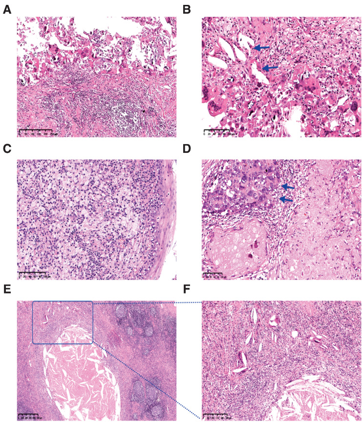 Figure 3. Significant tumor response was observed in the radical specimens. A and B, Fibrosis, lymphocyte infiltration, necrosis, cholesterol clefts (arrow), giant cell reaction, and calcification in primary tumor with pathological complete response (pCR). Hematoxylin–eosin. A, magnifications, ×100. B, magnifications, ×200. C, An aggregation of macrophages into the regression bed of HPV+ subject with pCR. Hematoxylin–eosin, magnifications, ×200. D, Acellular keratin and residual viable tumor (arrow) in the primary tumor with major pathological response (MPR). Hematoxylin–eosin, magnifications, ×200. E and F, Necrosis, histiocytes, cholesterol clefts, and giant cell reaction in metastatic lymph node with pCR. Hematoxylin–eosin. E, Magnifications, ×40. F, Magnifications, ×100. F, Is an enlargement within the square of (E).